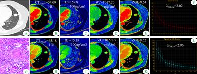 The value of dual-energy spectral CT in differentiating solitary pulmonary tuberculosis and solitary lung adenocarcinoma